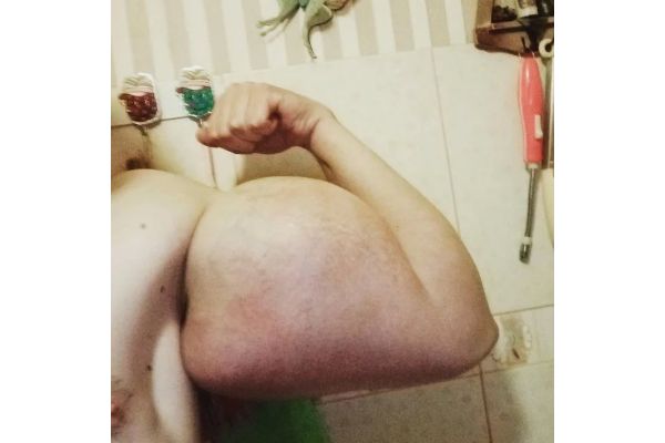 Ruski bodibilder uništio ruke jer je u njih ubrizgavao ulje