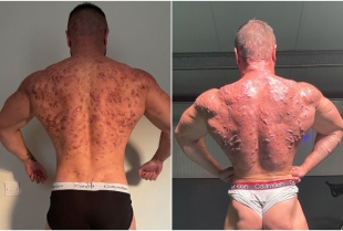 Bodibilder zbog steroida završio sa zastrašujućim ožiljcima na telu